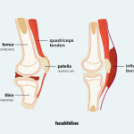 Bunions: Understanding the Bumpy Truth and Finding Relief