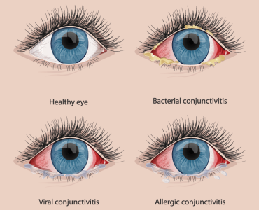 Conjunctivitis