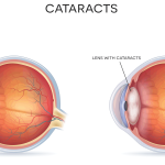 Beyond the Drip: Understanding and Managing Catarrh