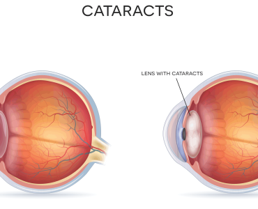 cataract
