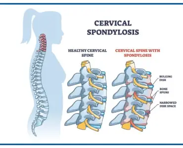 cervical-spondylosis-