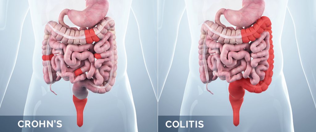 crohns-coliti