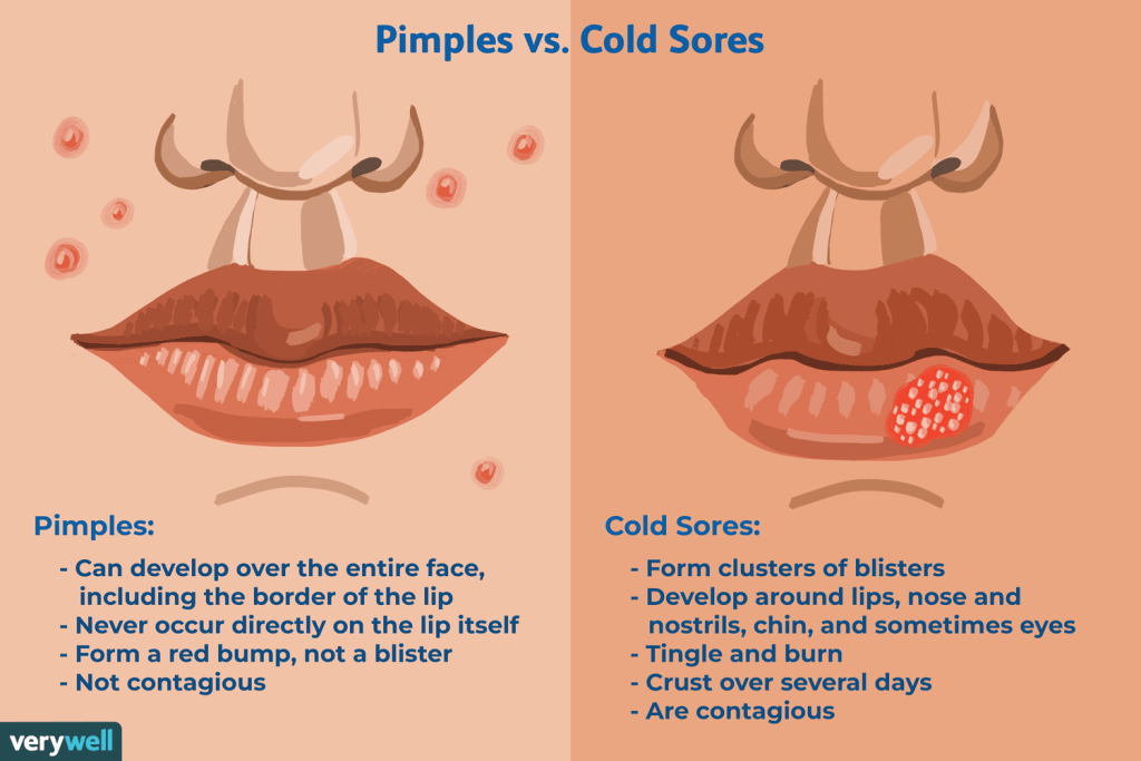 cold sores vs pimple