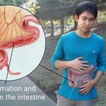 Deep Vein Thrombosis (DVT): Symptoms, Causes, and Treatment