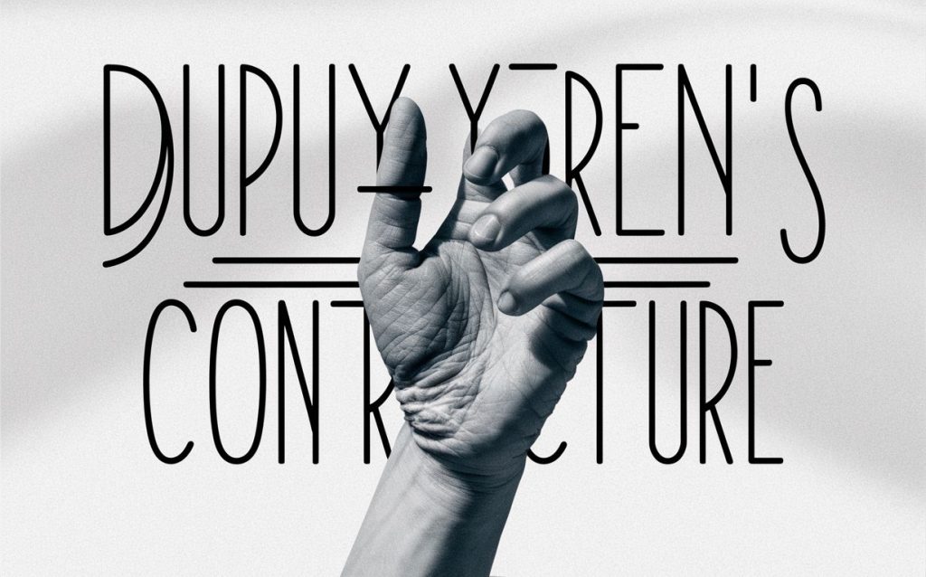 dupuytrens_contracture